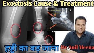 Exostosis Treatment  Exostosis cause and treatment  Osteochndroma  Osteophyte  Osteoma In Hindi [upl. by Gawain196]