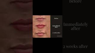 Lip filler in stages lipaugmentation drdonath [upl. by Lorenzana]