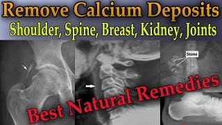 Remove Painful Calcium Deposits From Your Body 3 Best Home Remedies  Dr Mandell [upl. by Wallace]