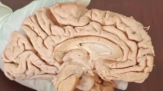 Anatomy of the human Brain  brain corpus callosum [upl. by Doubler]