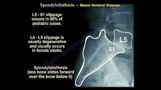 Low Back pain Spondylolysis Spondylolisthesis Spondylitis Spondylosis confusing spine names [upl. by Haldeman]