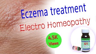 Eczema Treatment in Hindi।Electro Homeopathy me eczema ka ilaaj [upl. by Enyalb]