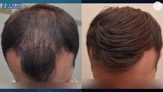 FUE 3027 Fu´s Dr Lupanzula MeDiKemos ENG hairtransplant [upl. by Derinna116]