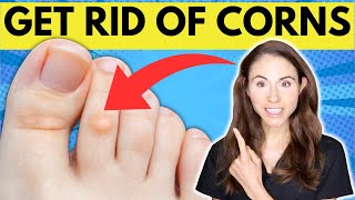 How To Get Rid Of Corns On The Feet [upl. by Newel]