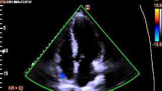 Doppler Tissular do Anel Mitral e Anel Tricúspide [upl. by Blayze311]