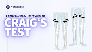 Craigs Test  Femoral Anteversion [upl. by Merlin]