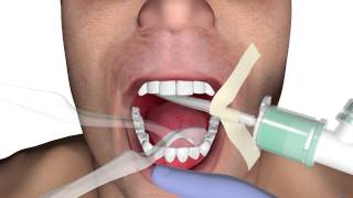 Performing the modified bass brushing technique for improved oral care [upl. by Esahc]