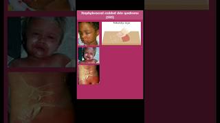 staphylococcal scalded skin syndrome SSSS [upl. by Atsocal394]