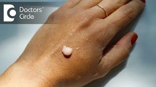 How to get rid of dark spots on hands occured after using whitening lotions  Dr Rajdeep Mysore [upl. by Old]