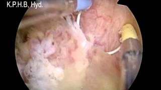 BLADDER TUMOR REMOVAL with Bipolar Preeti Urology and Kidney Hospital [upl. by Laird439]