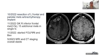 Multidisciplinary Care of Patients with Brain Metastases in the Era of Precision Medicine [upl. by Acnalb]