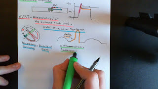 Cardiac Arrhythmias Part 7 [upl. by Deirdra]