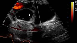 Hemorrhagic Corpus luteum cyst on Ultrasound scan [upl. by Ebert]