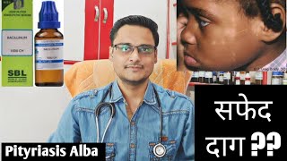 Pityriasis alba homeopathic treatment  explain चेहरे पर सफेद दाग [upl. by Nilrak]