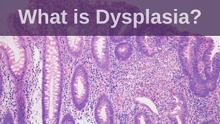 What is Dysplasia  Pathology mini tutorial [upl. by Azrim]