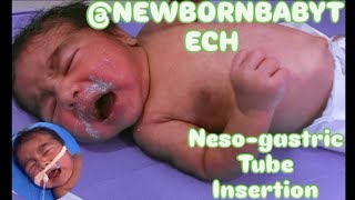 Nesogastric NG tube Insertion in neonatenewborn orogastric OG tube neonate feeding tube [upl. by Nanreik]