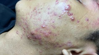 ACNE TREATMENT VU QUYNH MI Blackheads On Boy Face 2024 [upl. by Zerat403]