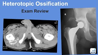 Heterotopic Ossification Exam Review  William Barrett MD [upl. by Itoc]