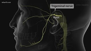 Trigeminal Neuralgia local doctors may have found the cure [upl. by Alexina]