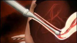 3D animation of how IVF works [upl. by Ycul]