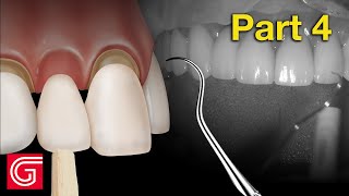 HOW TO TryIn Zirconia Crowns BEFORE Final Cementation [upl. by Royden]