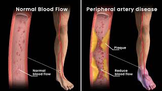 Peripheral Artery Disease Angioplasty [upl. by Aienahs]