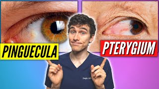 Pinguecula Vs Pterygium Signs Symptoms Treatment [upl. by Sarina323]