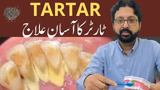 How to Remove TARTAR from Teeth at Home Naturally [upl. by Eineg48]