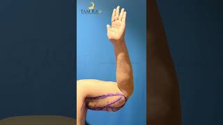 Brachioplasty Before and After  Arm Lift  Tamiralife Chennai [upl. by Adihsar]