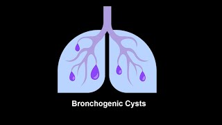 Bronchogenic Cysts Symptoms and Causes  Diagnosis  Treatment  Prevention disease healthcare [upl. by Auqinet]