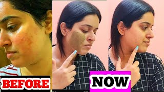 🔥REMOVE PIMPLES IN 2 DAYS😍 MAGICAL PIMPLE REMOVAL MASK😳INSTANT RESULTS😍 [upl. by Constanta319]