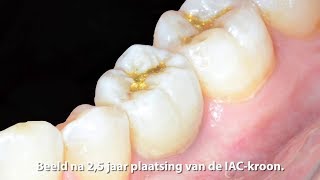 Extractie onmiddellijke plaatsing en restauratie van een eerste molaar in de onderkaak met een IAC [upl. by Dwinnell]