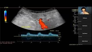 Doppler showing Stenosis of Carotid bifurcation NASCET criteria [upl. by Shaer]