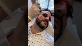 Depilación Laser  Marcación de Barba y espalda  Laser Fotona [upl. by Assyral]