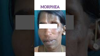 Morphea  एक ऐसी बिमारी जो चेहरे के मांस को सूखा देती है [upl. by Htessil]