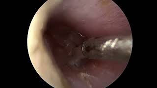 Ear tube placement myringotomy [upl. by Cagle]