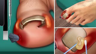 ASMR Ingrown toenail  Treatment corner of the toenail  Beautiful pedicure for girls [upl. by Hepsibah]