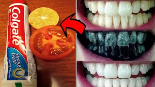 सिर्फ 2 मिनटों में पीले गंदे दांतो को मोतियों की तरह सफेद बना देगा ये नुस्खा  Teeth whitening home [upl. by Attwood638]