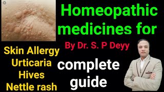 Homeopathy medicines for skin allergy  urticaria  nettel rash  itching  skin problems [upl. by Rayna46]