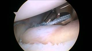 Arthroscopic SLAP repair  Artroscopia reinserción LABRUM [upl. by Joiner]