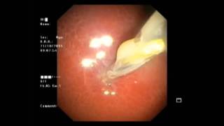 Endoscopic Pseudocyst drainage [upl. by Ociredef703]