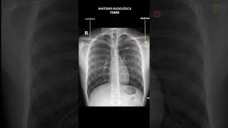 🦴📹 Anatomía radiológica de tórax [upl. by Bendicty]