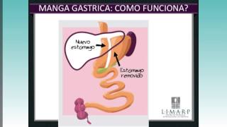 ¿Quién es candidato para Cirugía de Manga Gástrica  Entrevista con Dr Pompa  LIMARP BARIATRIC [upl. by Llezniuq]