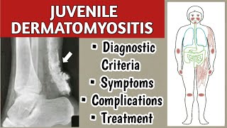 Juvenile Dermatomyositis Symptoms Diagnostic Criteria Complications and Treatment [upl. by Gosney574]