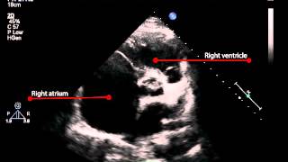 6B Parasternal short axis view of the left atrium and aorta Pulmonary Hypertension [upl. by Enajharas]