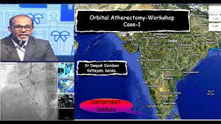 Orbital Atherectomy Workshop Case1 DrDeepak Davidson [upl. by Ihel]