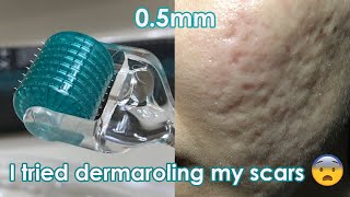 I tried dermarolling my ACNE SCARS  Demo  Review [upl. by Shornick932]