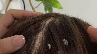 ASMR  Dandruff Removal amp Scalp Check Extremely Satisfying [upl. by Efioa]