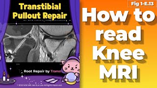 Fig 1E13 Transtibial Pullout Repair [upl. by Daeriam]