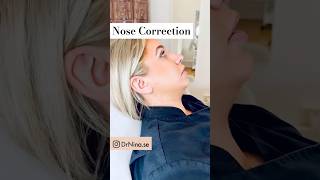 Nose Correction [upl. by Nwonknu]